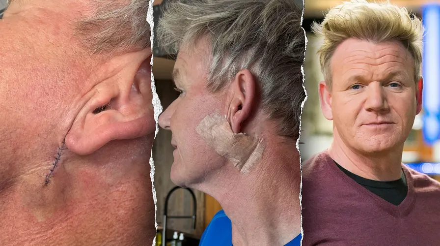 Gordon Ramsay reveals skin cancer surgery scar